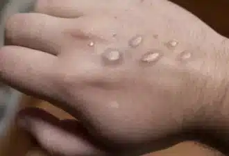 épidemie mpox