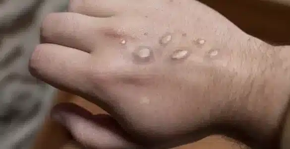 épidemie mpox