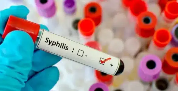 syphilis