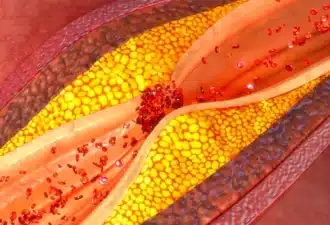 Diabète : un nouveau biomarqueur sanguin prédit le risque cardiovasculaire à dix ans