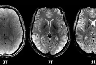 Imagerie médicale d'un cerveau humain