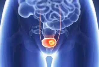 Vesica Health lance un nouveau test révolutionnaire pour la détection du cancer de la vessie