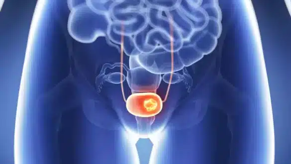 Vesica Health lance un nouveau test révolutionnaire pour la détection du cancer de la vessie