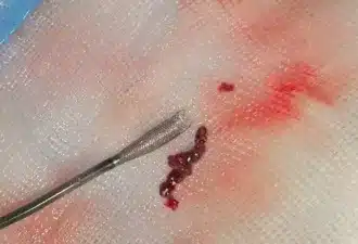 Ceretrieve révolutionne le traitement des AVC